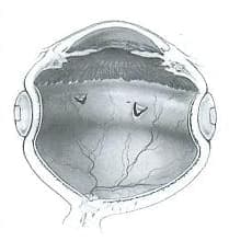 強膜バックルによる網膜裂孔閉鎖