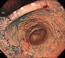 Fig1.早期胃癌