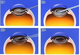 白内障の手術