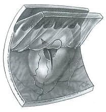 硝子体による網膜裂孔の発生