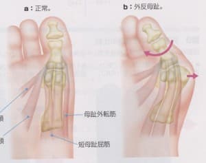 外反母趾 イメージ02