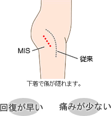 MIS（最小侵襲手術）とは？
