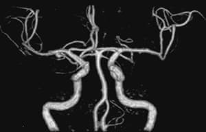 頭部血管MRA画像01