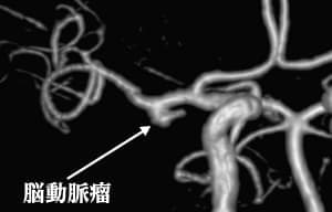 頭部血管MRA画像02