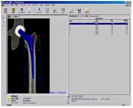 人工股関節周囲の骨を計測するソフト