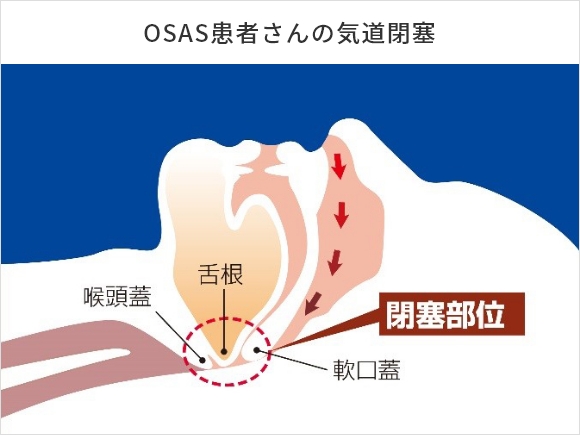 閉塞性睡眠時無呼吸症候群の原因 イメージ画像