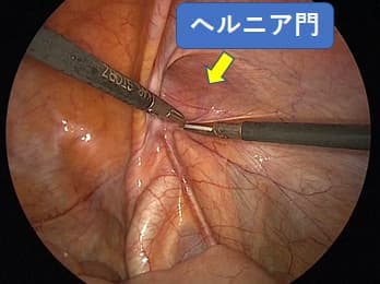 腹膜を切開するところ