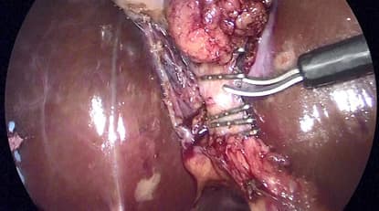 胆嚢管（胆嚢の根本の管）を切除するところ
